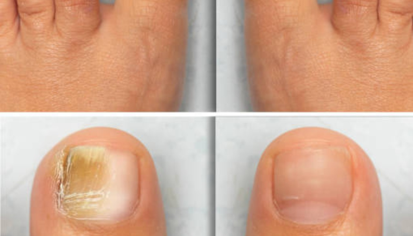 Fungal Nails wellness guide