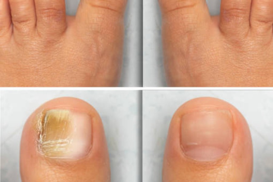 Fungal Nails